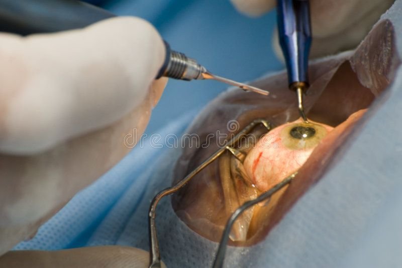 cornea transplant cost in india