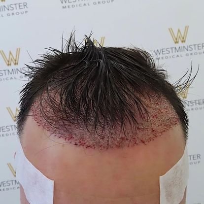 Best Hair Transplant In Mumbai