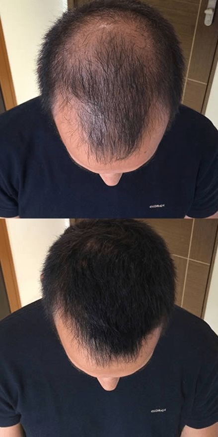 affordable hair transplant surgery