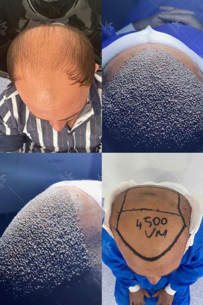 Best Hair Transplant in Mumbai