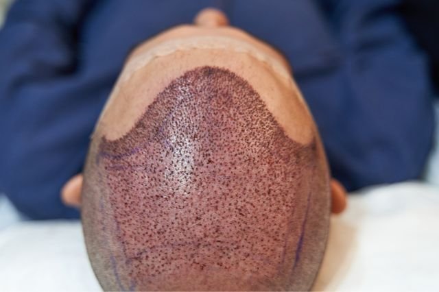 best Hair Transplant in India
