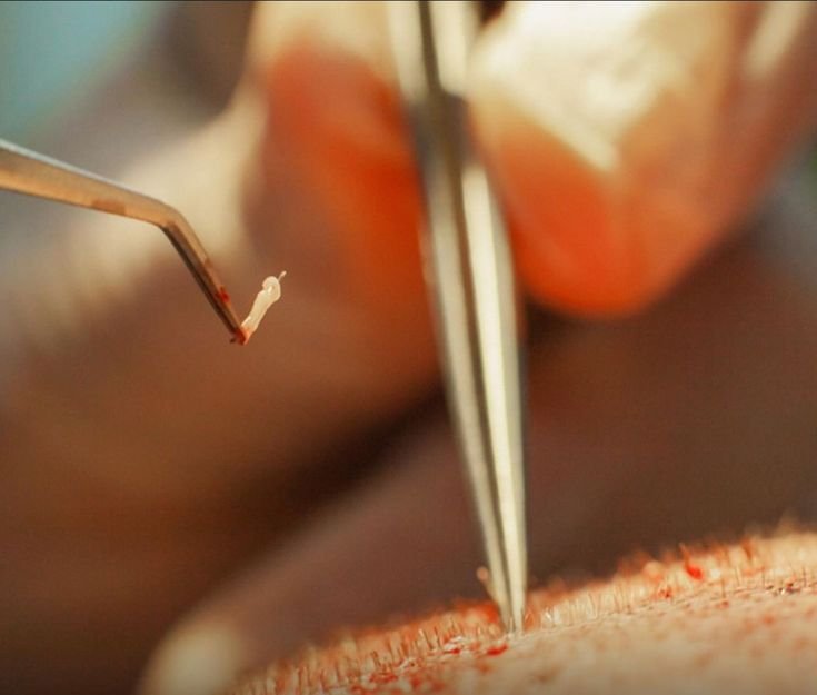 Affordable Hair Transplant in Mumbai
