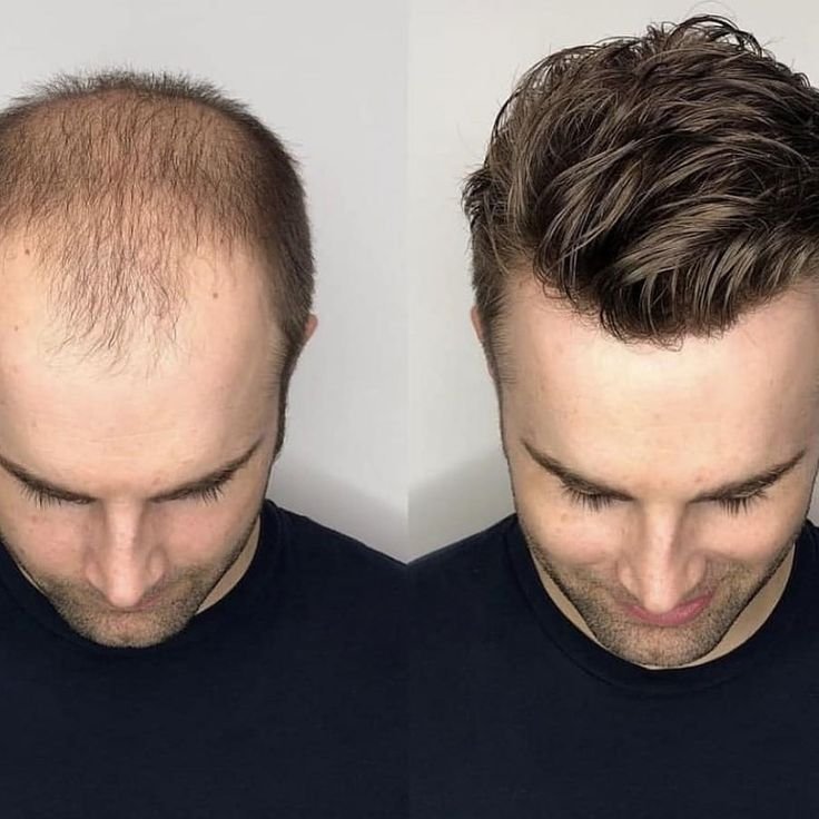 Hair Transplant Cost in Mumbai