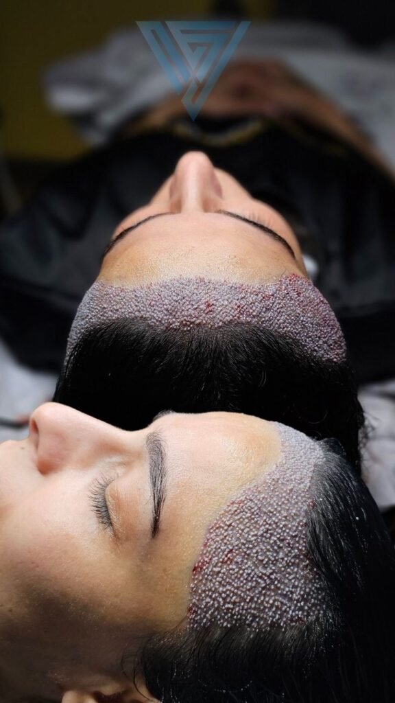 Hair Transplant in India