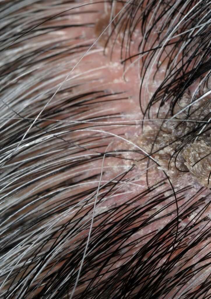 Best Hair Treatment in India