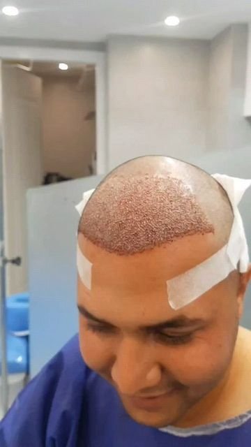 Hair Transplant in India