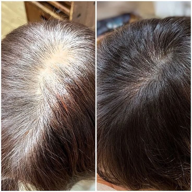 Hair Loss Scalp
