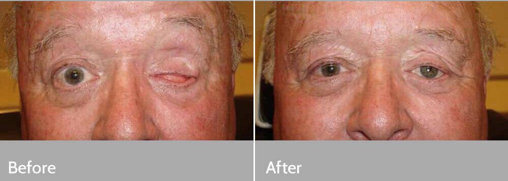 eye transplant in navi mumbai