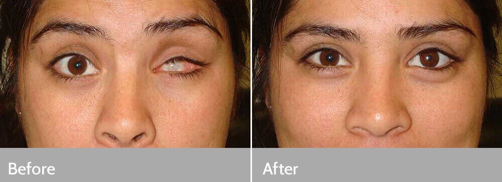 eye transplant in navi mumbai