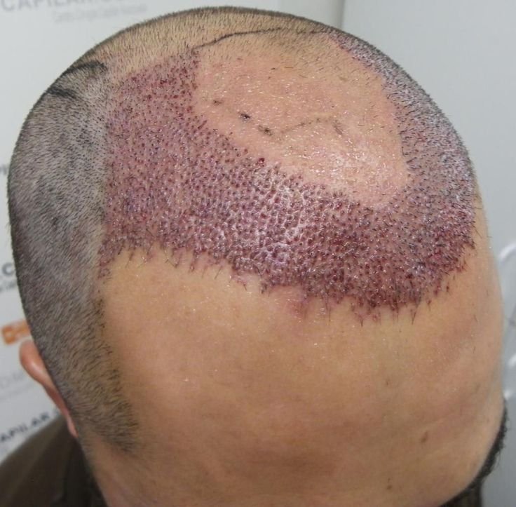 Hairfall related problems Mumbai