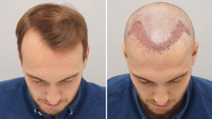 Hair transplant inIndia