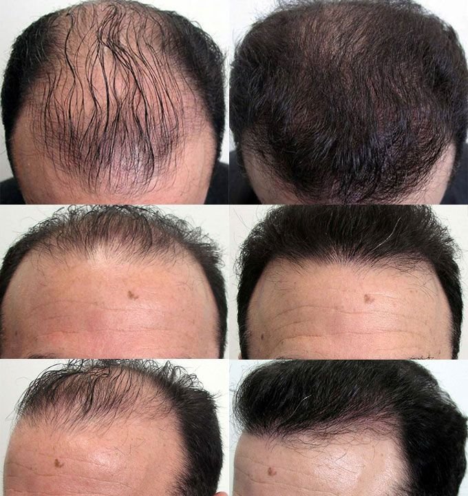 PRP Hair Restoration in Mumbai