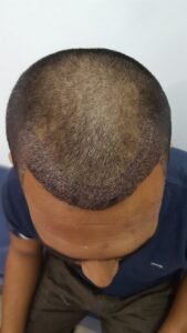 Hair Transplant Navi Mumbai