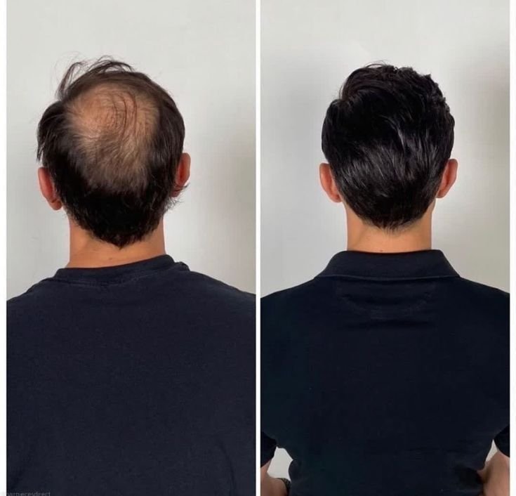 Hair-Loss Solutions Navi Mumbai