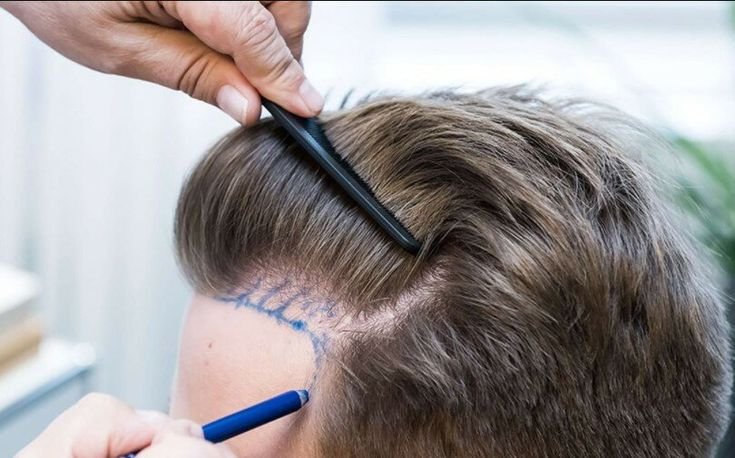 Best Hair Transplant in Mumbai