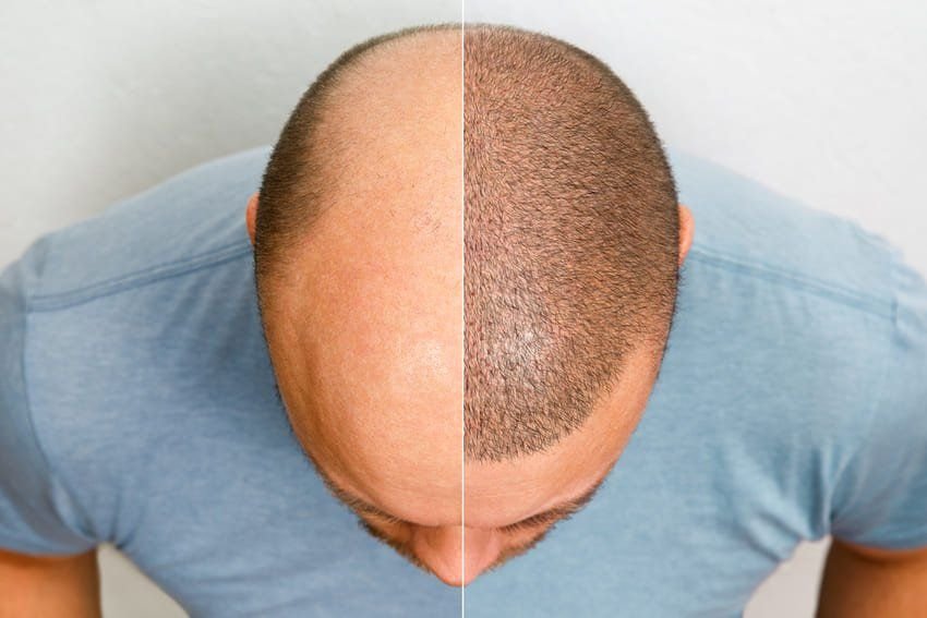 hair transplant in Mumbai