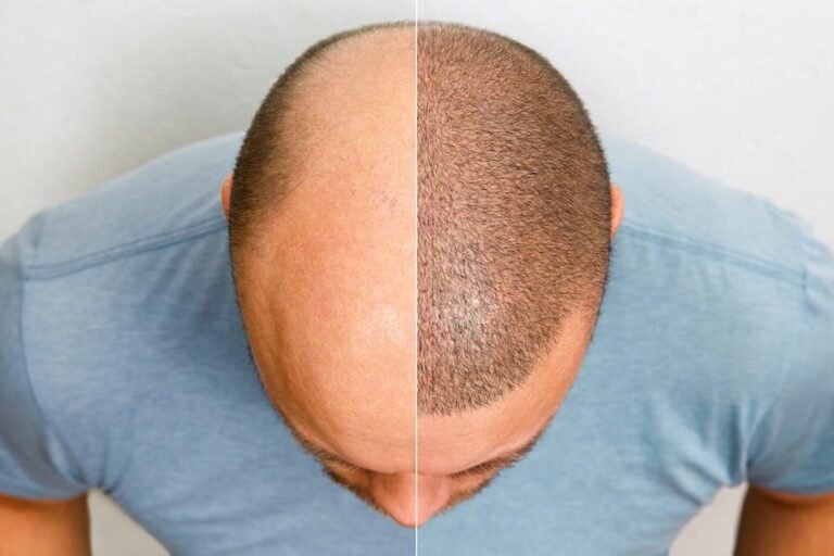 Affordable hair transplant india