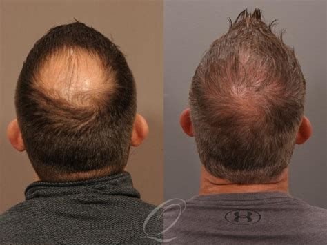 FUE Treatment India Africa