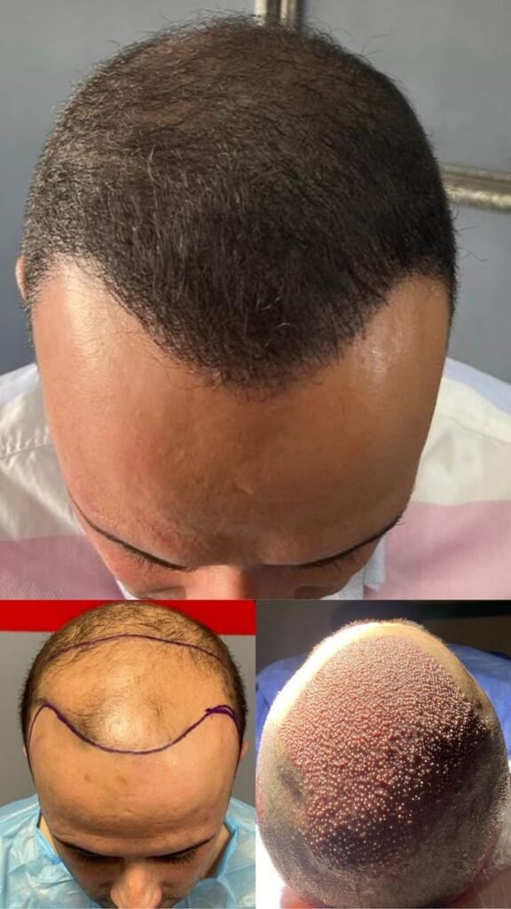 Hair Restoration Surgery Cost in Panvel