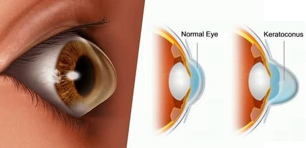 affordable cornea transplantation in India