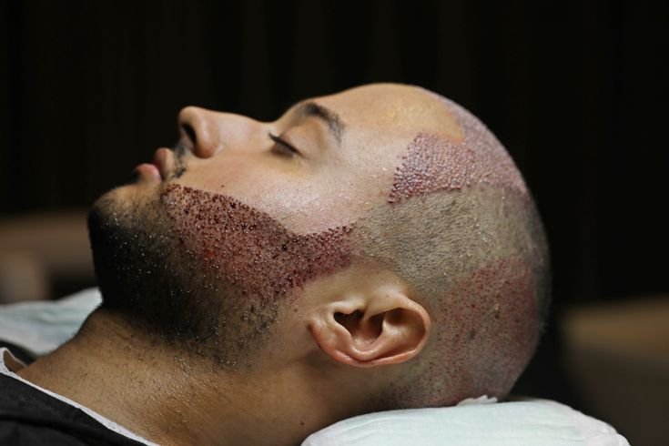 Affordable DHI Hair Transplant Mumbai