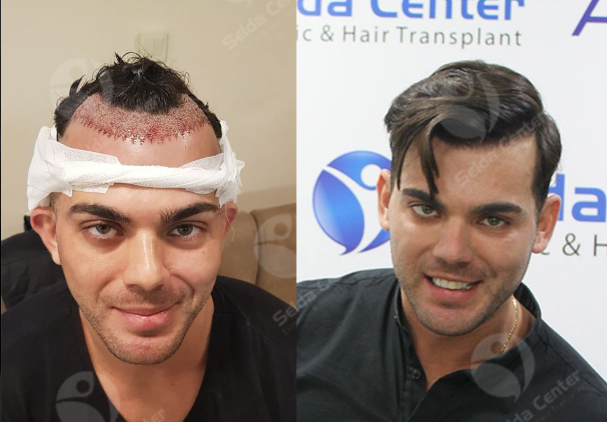 DHI Hair Transplant Mumbai