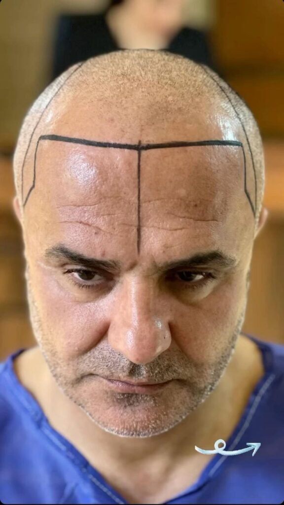 Top Hair Transplant in Navi Mumbai