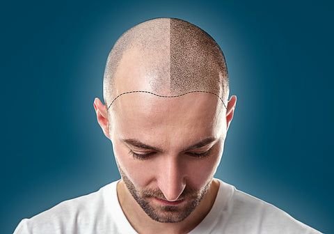 hair transplant
