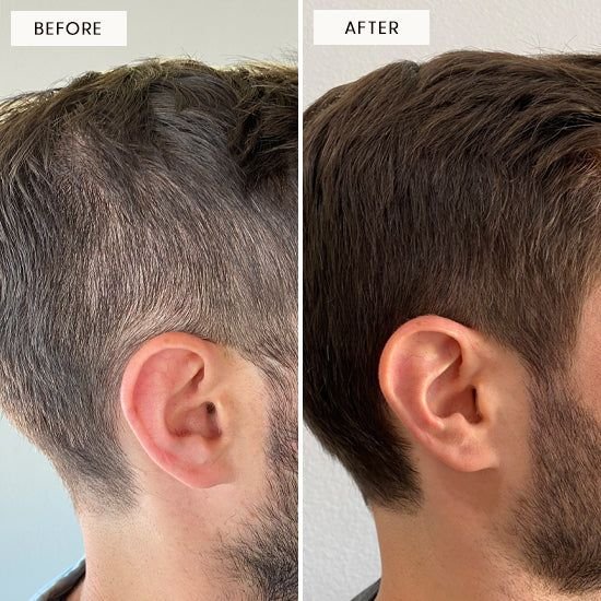 hair transplant in Thailand