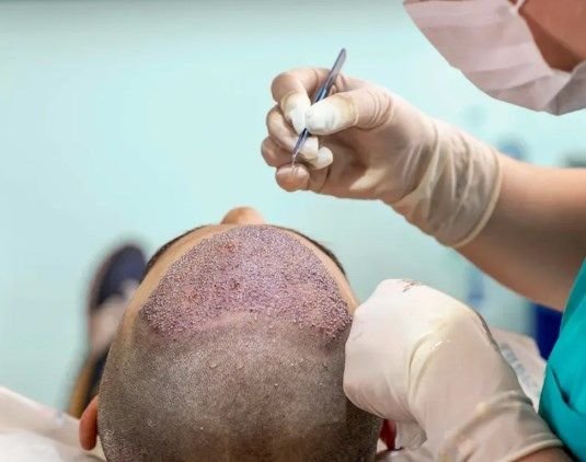 Hair Transplant Thailand